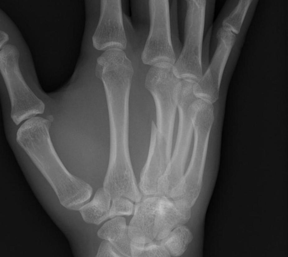 Metacarpal Fracture Minimally Displaced